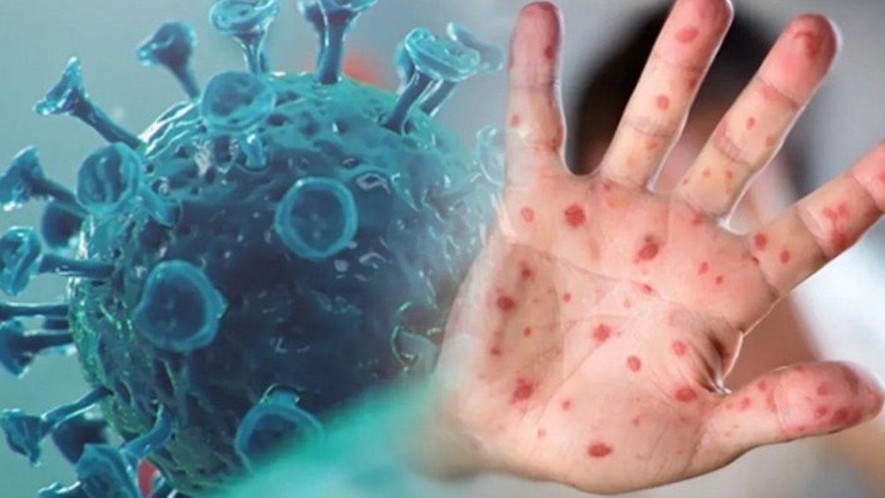 KTÜ RESMEN AÇIKLADI MAYMUN ÇİÇEĞİ HASTALIĞI TEDAVİ EDİLEBİLİR Mİ?